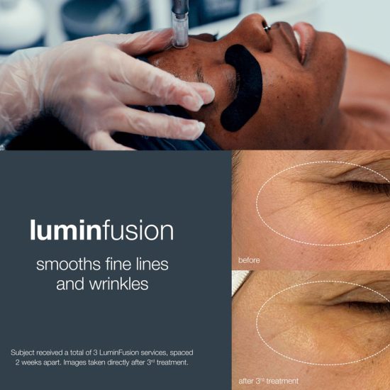 Lumifusion