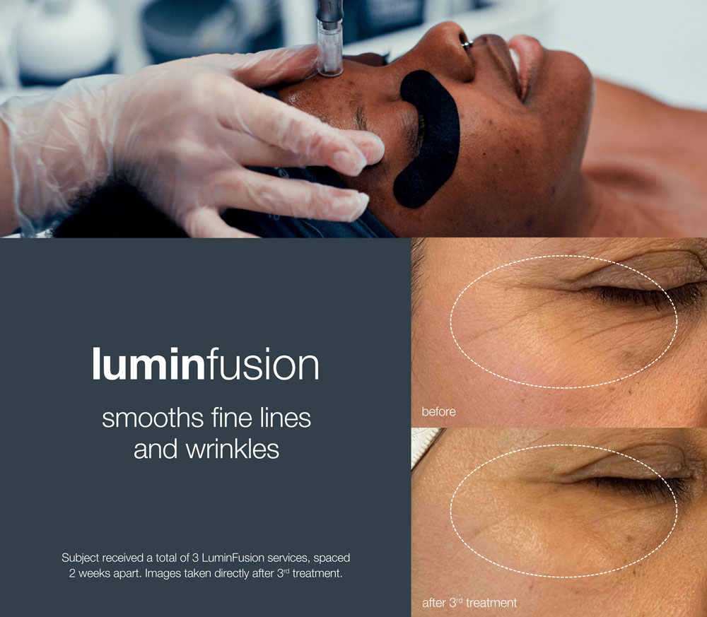 Lumifusion